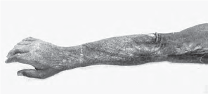 Keloid scar on Hirano’s right arm taken long after the Hiroshima bombing. 
